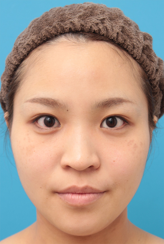 隆鼻術（シリコンプロテーゼ）,鼻に3mmのシリコンプロテーゼを入れ、自然に鼻筋を通した症例写真,Before,ba_ryubi67_b.jpg