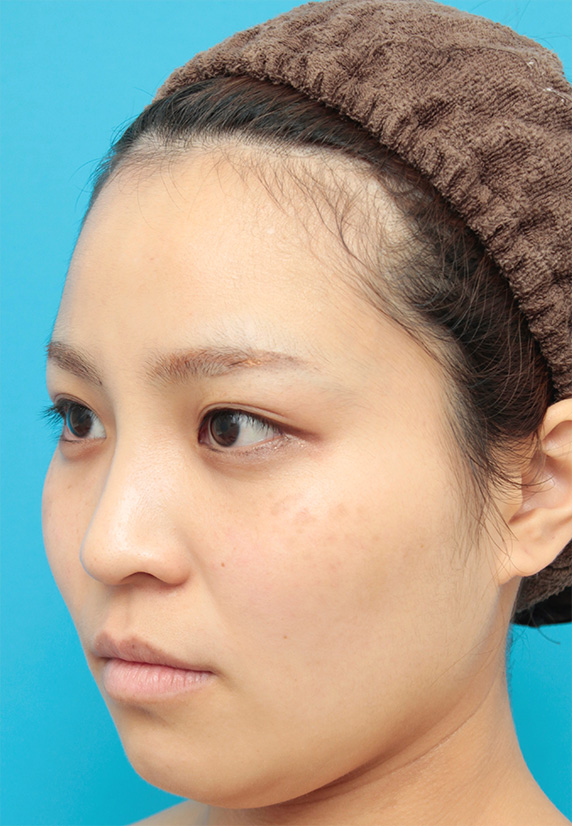 隆鼻術（シリコンプロテーゼ）,鼻に3mmのシリコンプロテーゼを入れ、自然に鼻筋を通した症例写真,After（6ヶ月後）,ba_ryubi68_b.jpg
