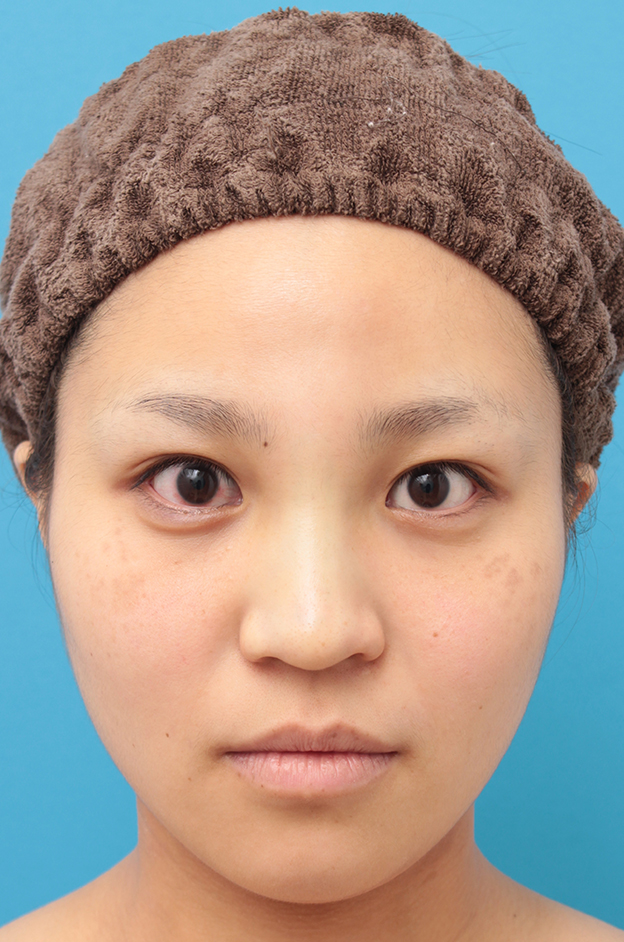 症例写真,鼻に3mmのシリコンプロテーゼを入れ、自然に鼻筋を通した症例写真,手術直後,mainpic_ryubi16b.jpg