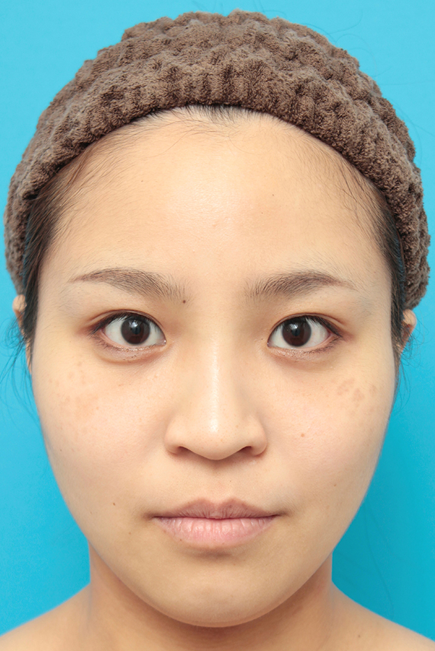 症例写真,鼻に3mmのシリコンプロテーゼを入れ、自然に鼻筋を通した症例写真,1週間後,mainpic_ryubi16c.jpg