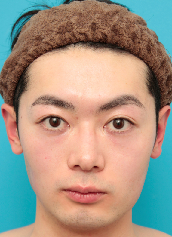 眉間~鼻筋にかけてのシリコンプロテーゼ+ボツリヌストキシン注射（エラ、プチ小顔術）をした20代男性の症例写真,Before,ba_ryubi70_b.jpg
