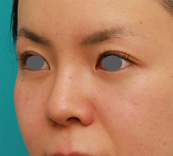 隆鼻術（シリコンプロテーゼ）,鼻のシリコンプロテーゼと小鼻（鼻翼）縮小手術をした20代女性の症例写真,After（6ヶ月後）,ba_ryubi75_b.jpg