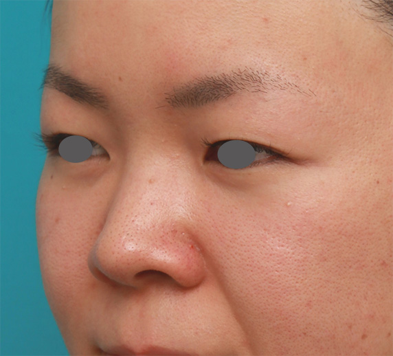鼻翼縮小（小鼻縮小）,鼻のシリコンプロテーゼと小鼻（鼻翼）縮小手術をした20代女性の症例写真,Before,ba_ryubi75_b.jpg