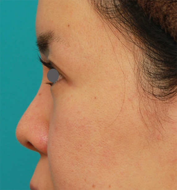隆鼻術（シリコンプロテーゼ）,鼻のシリコンプロテーゼと小鼻（鼻翼）縮小手術をした20代女性の症例写真,After（6ヶ月後）,ba_ryubi76_b.jpg