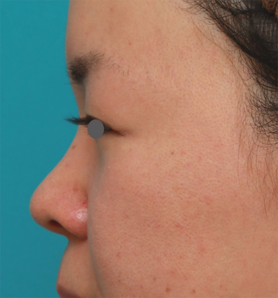鼻翼縮小（小鼻縮小）,鼻のシリコンプロテーゼと小鼻（鼻翼）縮小手術をした20代女性の症例写真,Before,ba_ryubi76_b.jpg