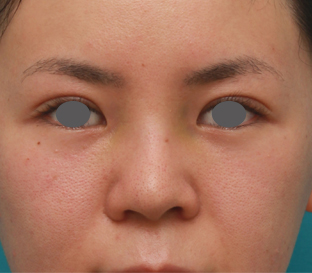 鼻翼縮小（小鼻縮小）,鼻のシリコンプロテーゼと小鼻（鼻翼）縮小手術をした20代女性の症例写真,1週間後,mainpic_ryubi18c.jpg