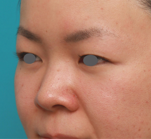 隆鼻術（シリコンプロテーゼ）,鼻のシリコンプロテーゼと小鼻（鼻翼）縮小手術をした20代女性の症例写真,手術前,mainpic_ryubi18e.jpg