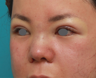 隆鼻術（シリコンプロテーゼ）,鼻のシリコンプロテーゼと小鼻（鼻翼）縮小手術をした20代女性の症例写真,手術直後,mainpic_ryubi18f.jpg