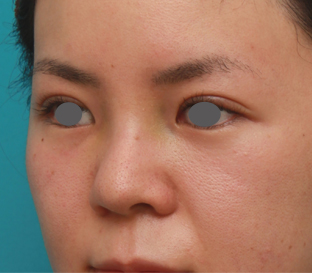 隆鼻術（シリコンプロテーゼ）,鼻のシリコンプロテーゼと小鼻（鼻翼）縮小手術をした20代女性の症例写真,1週間後,mainpic_ryubi18g.jpg