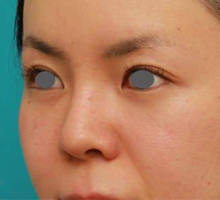 隆鼻術（シリコンプロテーゼ）,鼻のシリコンプロテーゼと小鼻（鼻翼）縮小手術をした20代女性の症例写真,6ヶ月後,mainpic_ryubi18h.jpg