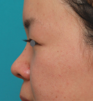 隆鼻術（シリコンプロテーゼ）,鼻のシリコンプロテーゼと小鼻（鼻翼）縮小手術をした20代女性の症例写真,手術前,mainpic_ryubi18i.jpg