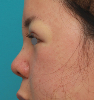 隆鼻術（シリコンプロテーゼ）,鼻のシリコンプロテーゼと小鼻（鼻翼）縮小手術をした20代女性の症例写真,手術直後,mainpic_ryubi18j.jpg