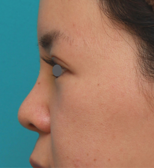 鼻翼縮小（小鼻縮小）,鼻のシリコンプロテーゼと小鼻（鼻翼）縮小手術をした20代女性の症例写真,1週間後,mainpic_ryubi18k.jpg