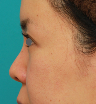 鼻翼縮小（小鼻縮小）,鼻のシリコンプロテーゼと小鼻（鼻翼）縮小手術をした20代女性の症例写真,6ヶ月後,mainpic_ryubi18m.jpg