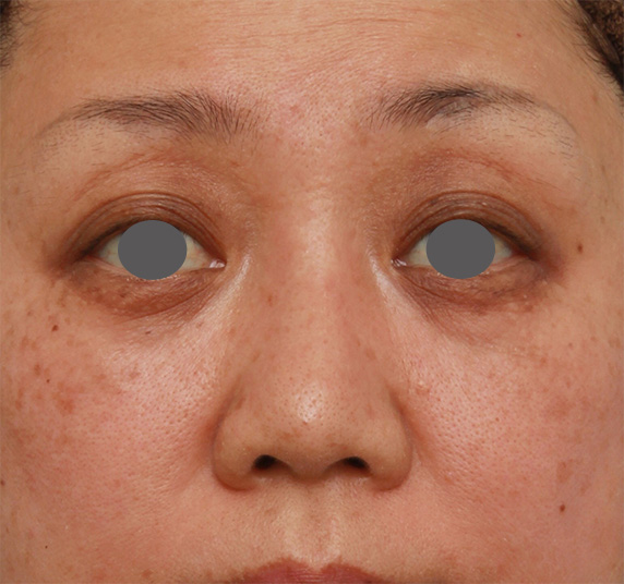 症例写真,40代後半女性の低い鼻にシリコンプロテーゼを入れて高くした症例写真の術前術後画像,After（2ヶ月後）,ba_ryubi77_b.jpg