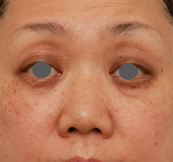 40代後半女性の低い鼻にシリコンプロテーゼを入れて高くした症例写真の術前術後画像,Before,ba_ryubi77_b.jpg