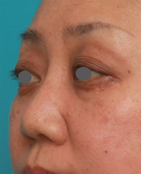 隆鼻術（シリコンプロテーゼ）,40代後半女性の低い鼻にシリコンプロテーゼを入れて高くした症例写真の術前術後画像,After（2ヶ月後）,ba_ryubi78_b.jpg