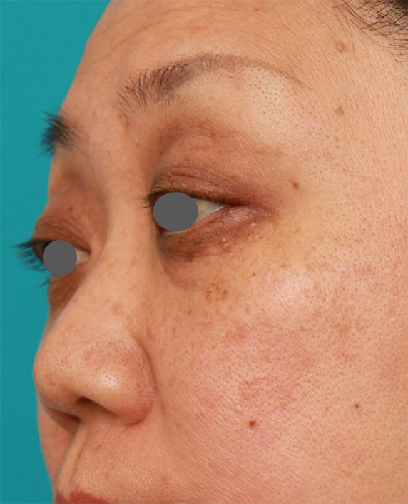 隆鼻術（シリコンプロテーゼ）,40代後半女性の低い鼻にシリコンプロテーゼを入れて高くした症例写真の術前術後画像,Before,ba_ryubi78_b.jpg