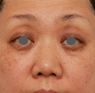 隆鼻術（シリコンプロテーゼ）,40代後半女性の低い鼻にシリコンプロテーゼを入れて高くした症例写真の術前術後画像,手術前,mainpic_ryubi19a.jpg