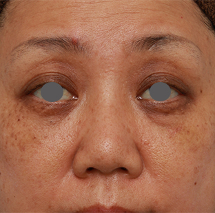 隆鼻術（シリコンプロテーゼ）,40代後半女性の低い鼻にシリコンプロテーゼを入れて高くした症例写真の術前術後画像,1週間後,mainpic_ryubi19c.jpg