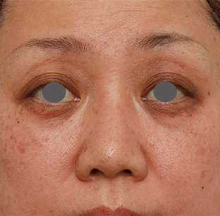 隆鼻術（シリコンプロテーゼ）,40代後半女性の低い鼻にシリコンプロテーゼを入れて高くした症例写真の術前術後画像,2ヶ月後,mainpic_ryubi19d.jpg