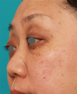 症例写真,40代後半女性の低い鼻にシリコンプロテーゼを入れて高くした症例写真の術前術後画像,手術前,mainpic_ryubi19e.jpg