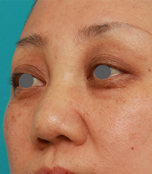 隆鼻術（シリコンプロテーゼ）,40代後半女性の低い鼻にシリコンプロテーゼを入れて高くした症例写真の術前術後画像,手術直後,mainpic_ryubi19f.jpg