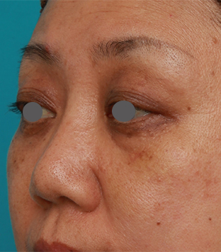 隆鼻術（シリコンプロテーゼ）,40代後半女性の低い鼻にシリコンプロテーゼを入れて高くした症例写真の術前術後画像,1週間後,mainpic_ryubi19g.jpg