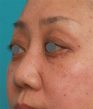 隆鼻術（シリコンプロテーゼ）,40代後半女性の低い鼻にシリコンプロテーゼを入れて高くした症例写真の術前術後画像,2ヶ月後,mainpic_ryubi19h.jpg