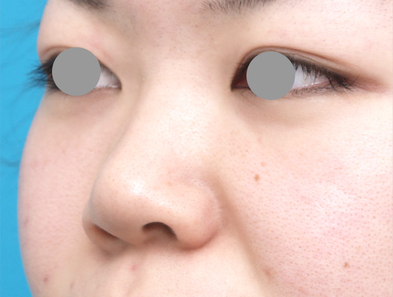 症例写真,隆鼻注射（ヒアルロン酸注射）の症例 施術できれいに鼻筋が通った20代女性,Before,ba_ryubichusha20_b.jpg