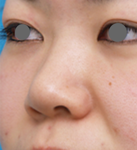 隆鼻注射（ヒアルロン酸注射）,隆鼻注射（ヒアルロン酸注射）の症例 施術できれいに鼻筋が通った20代女性,施術前,mainpic_ryubi2a.jpg