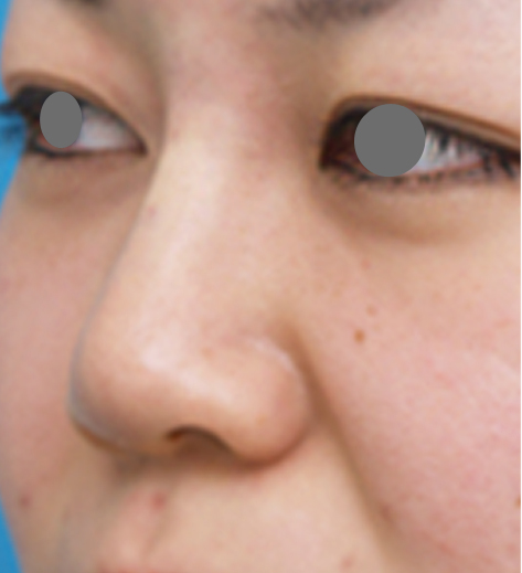 隆鼻注射（ヒアルロン酸注射）,隆鼻注射（ヒアルロン酸注射）の症例 施術できれいに鼻筋が通った20代女性,施術直後,mainpic_ryubi2b.jpg