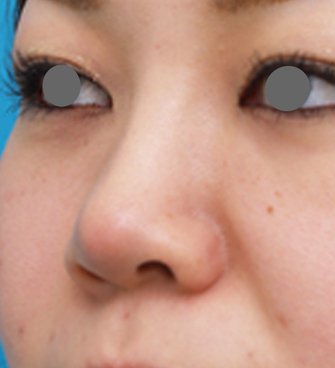隆鼻注射（ヒアルロン酸注射）,隆鼻注射（ヒアルロン酸注射）の症例 施術できれいに鼻筋が通った20代女性,1週間後,mainpic_ryubi2c.jpg