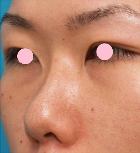 隆鼻注射（ヒアルロン酸注射）の症例 鼻先が上にむいていた20代男性,Before,ba_ryubichusha22_b.jpg