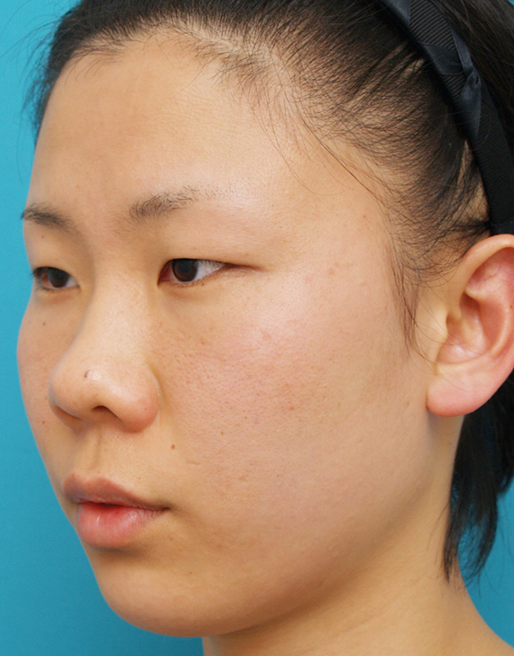 症例写真,隆鼻注射（ヒアルロン酸注射）の症例 目と目の間がくぼんでいた20代女性,Before,ba_ryubichusha18_b.jpg