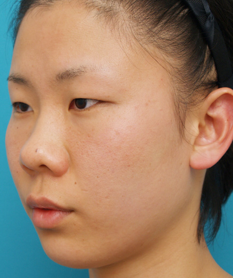 症例写真,隆鼻注射（ヒアルロン酸注射）の症例 目と目の間がくぼんでいた20代女性,施術前,mainpic_ryubi03a.jpg