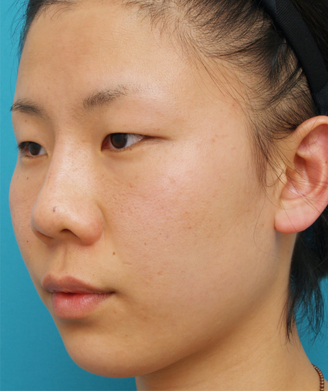 隆鼻注射（ヒアルロン酸注射）,隆鼻注射（ヒアルロン酸注射）の症例 目と目の間がくぼんでいた20代女性,施術直後,mainpic_ryubi03b.jpg