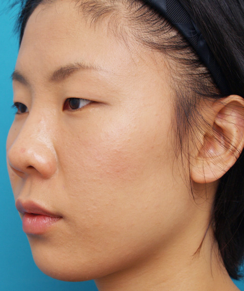 症例写真,隆鼻注射（ヒアルロン酸注射）の症例 目と目の間がくぼんでいた20代女性,1週間後,mainpic_ryubi03c.jpg