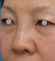 ヒアルロン酸分解・溶解（ヒアルロニダーゼ注射）,他院で安価なヒアルロン酸を鼻に注射してアバターのようになった方の修正症例写真,Before,ba_ryubichusha24_b.jpg