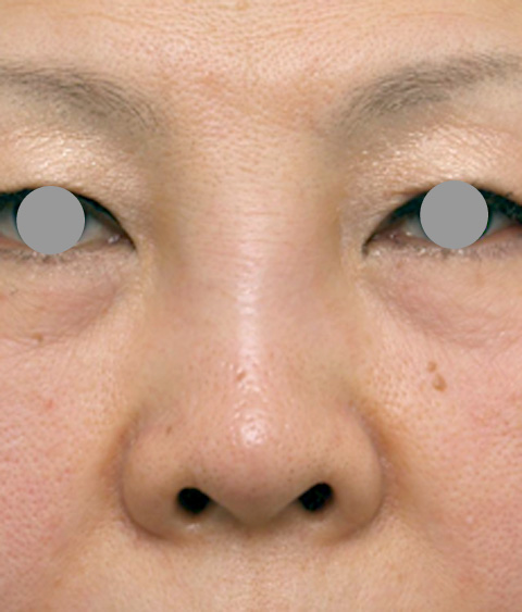 隆鼻注射（ヒアルロン酸注射）,他院で安価なヒアルロン酸を鼻に注射してアバターのようになった方の修正症例写真,施術前,mainpic_ryubi7a.jpg