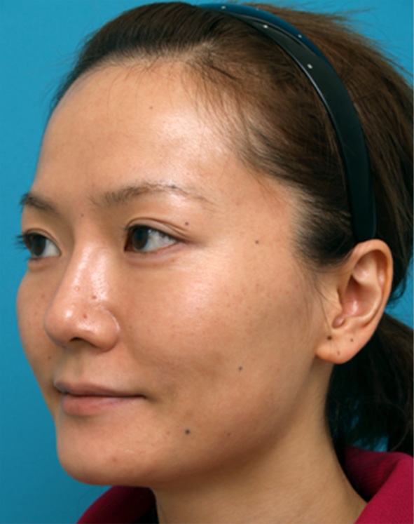 隆鼻注射（ヒアルロン酸注射）,隆鼻注射（ヒアルロン酸注射）の症例 鼻と涙袋をプチ整形した20代女性,After,ba_ryubichusha27_b.jpg