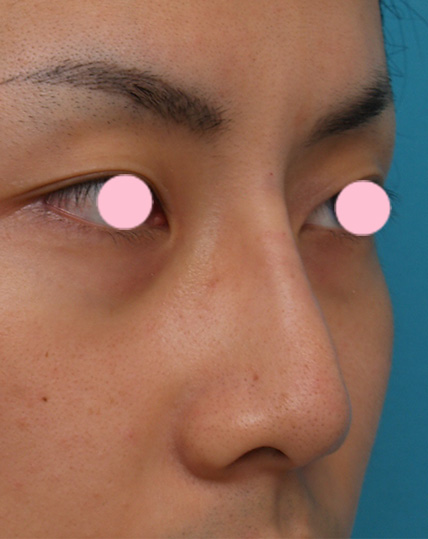 隆鼻注射（ヒアルロン酸注射）,ヒアルロン酸注射で鷲鼻の修正をした症例写真,After,ba_ryubichusha28_b.jpg