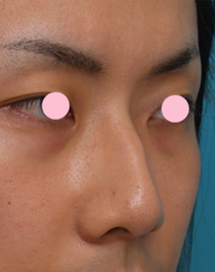 わし鼻・段鼻修正,ハンプ切除,ヒアルロン酸注射で鷲鼻の修正をした症例写真,Before,ba_ryubichusha28_b.jpg
