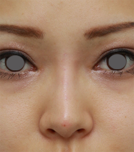 隆鼻注射（ヒアルロン酸注射）,長期持続型ヒアルロン酸で鼻を高くした症例写真,After（注射直後）,ba_ryubichusha29_a01.jpg
