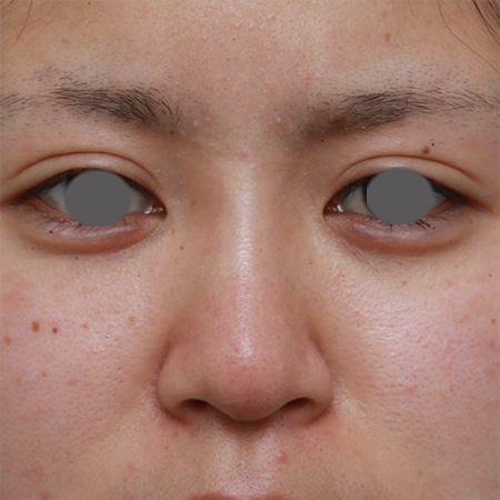 隆鼻注射（ヒアルロン酸注射）,鼻根部（鼻の目と目の間の部分）にヒアルロン酸注射して、鼻筋を通した症例写真,After（3ヶ月後）,ba_ryubichusha31_b.jpg
