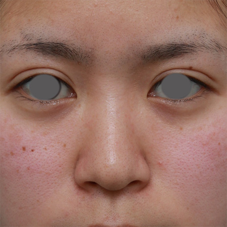 隆鼻注射（ヒアルロン酸注射）,鼻根部（鼻の目と目の間の部分）にヒアルロン酸注射して、鼻筋を通した症例写真,Before,ba_ryubichusha31_b.jpg
