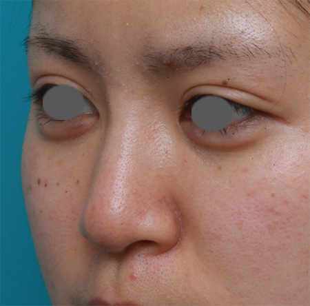 隆鼻注射（ヒアルロン酸注射）,鼻根部（鼻の目と目の間の部分）にヒアルロン酸注射して、鼻筋を通した症例写真,After（3ヶ月後）,ba_ryubichusha32_b.jpg