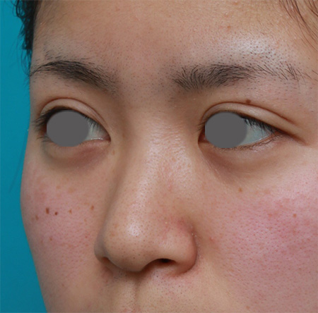 隆鼻注射（ヒアルロン酸注射）,鼻根部（鼻の目と目の間の部分）にヒアルロン酸注射して、鼻筋を通した症例写真,Before,ba_ryubichusha32_b.jpg
