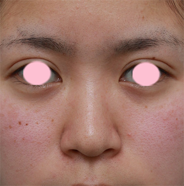 隆鼻注射（ヒアルロン酸注射）,鼻根部（鼻の目と目の間の部分）にヒアルロン酸注射して、鼻筋を通した症例写真,注射前,mainpic_ryubi12a.jpg