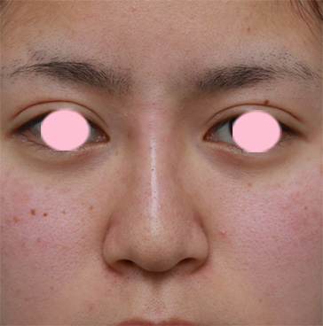 隆鼻注射（ヒアルロン酸注射）,鼻根部（鼻の目と目の間の部分）にヒアルロン酸注射して、鼻筋を通した症例写真,注射直後,mainpic_ryubi12b.jpg